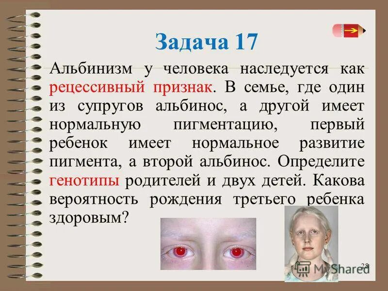 Тип наследования альбинизма у людей. Альбинизм генетика задачи. Альбинизм наследственное заболевание у человека. Альбинизм задачи по генетике.