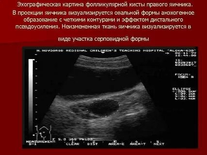 Жидкостное образование правого яичника