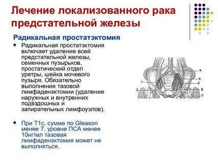 Что такое карцинома предстательной железы