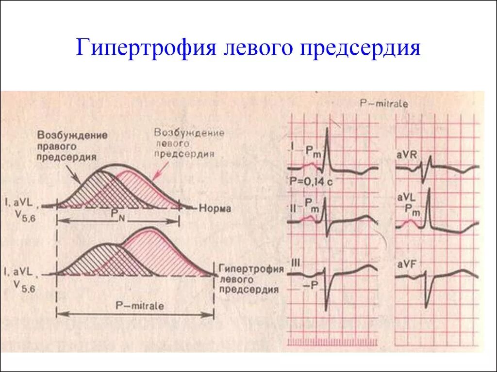 Критерии гипертрофии левого предсердия на ЭКГ. Гипертрофия левого предсердия на ЭКГ. ЭКГ при гипертрофии правого предсердия. Признаки гипертрофии левого предсердия на ЭКГ. Экг преобладание левого желудочка