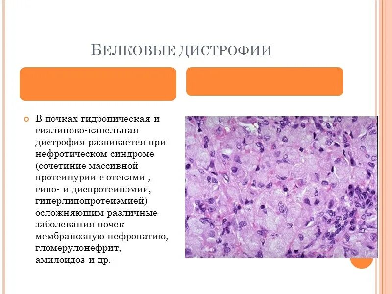 Общие дистрофии. Механизм образования белковой дистрофии. гиалиново капельная белковая дистрофия орган и внешний вид. белковая дистрофия патанатомия. дистрофия таблица.