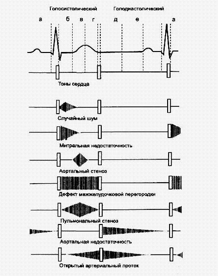 тоны сердца при пороках. сопоставление экг и фкг. соотношение тонов и шумов сердца. сопоставление экг и фкг. функциональные шумы сердца, данные фкг.