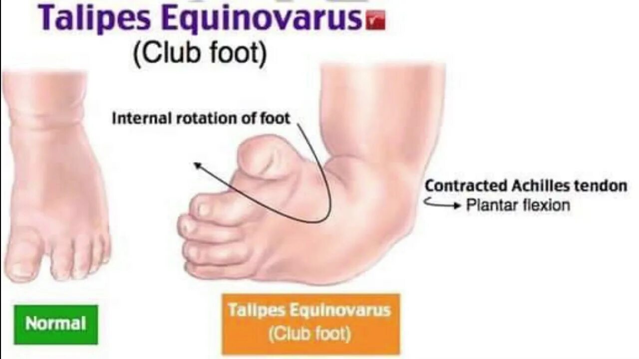 Касабиан клуб фут. Club foot перевод. Эквиноварусная косолапость. Club foot перевод. Club foot перевод.
