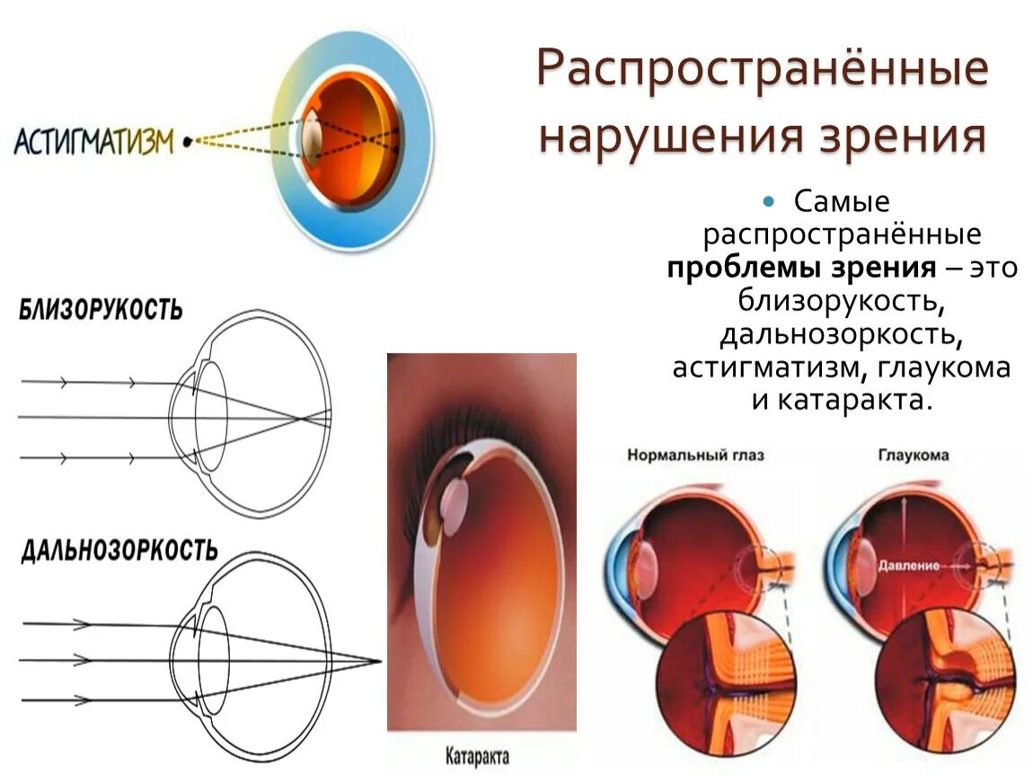 Миопия что это простыми словами. Миопия гиперметропия астигматизм. Аномалии рефракции: дальнозоркость, близорукость, астигматизм.. Нарушение зрения таблица астигматизм. Миопия 2 степени сложный миопический астигматизм.