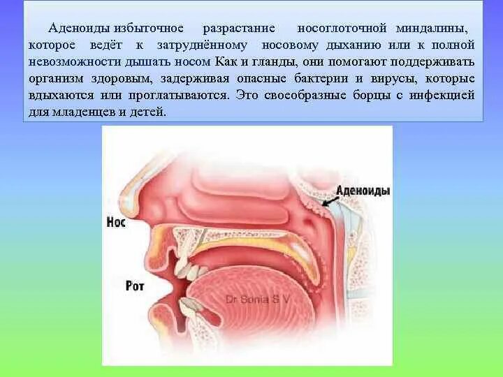 Придаточные пазухи носа. Миндалины, аденоиды.. Аденоиды носоглоточные миндалины. Строение горла аденоиды.