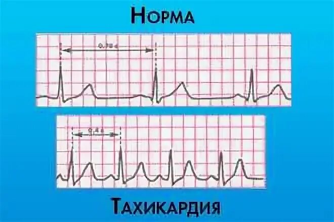 Тахикардия берут ли