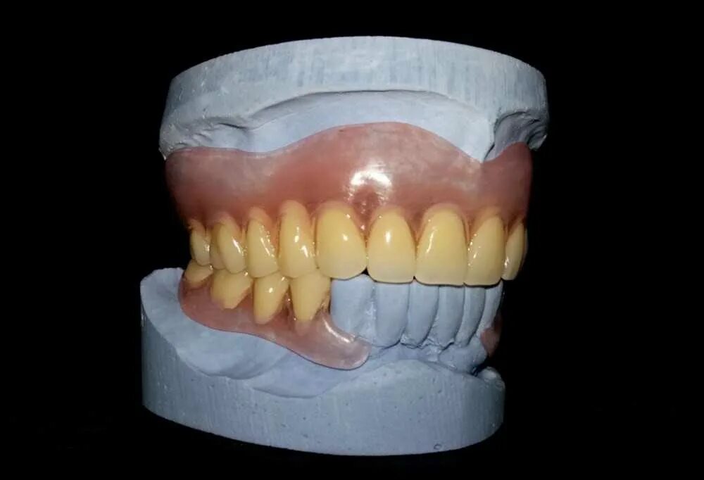 Частичный нейлоновый протез (от 4 до 13 зубов). Полный съемный нейлоновый протез.