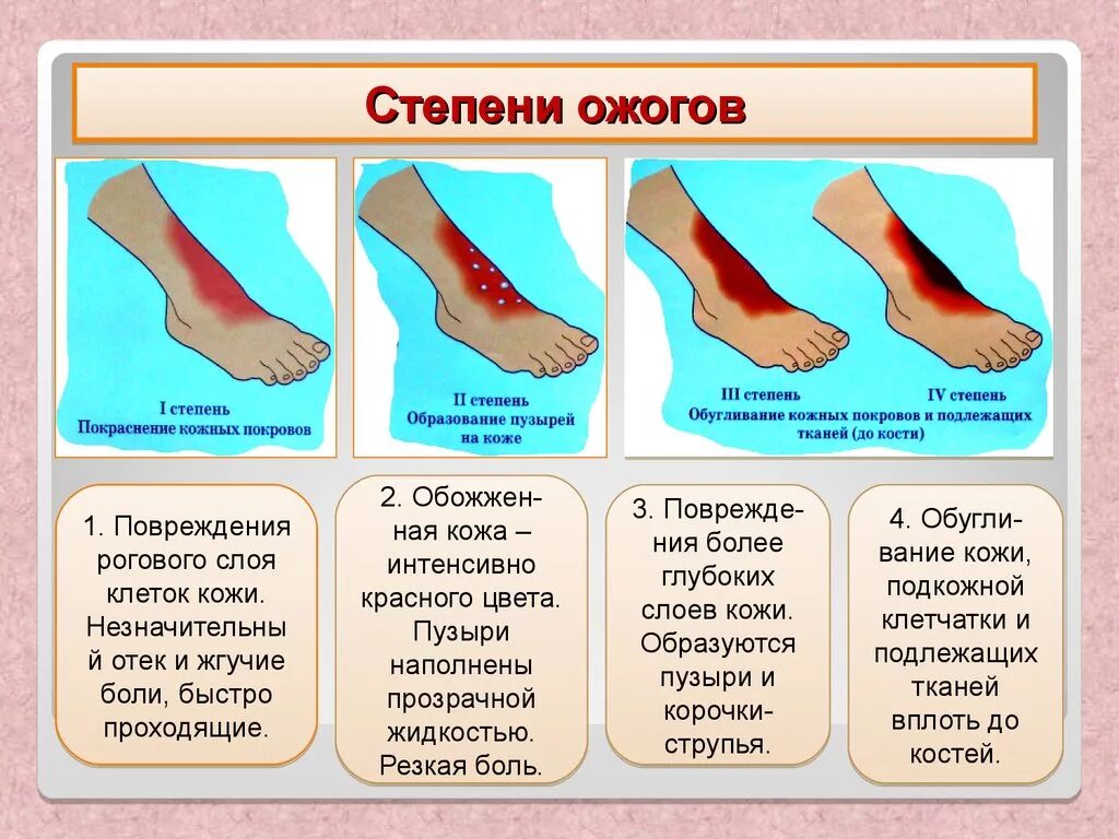 Ожоги обж 8 класс. Ожоги 1 степень 2 степень 3 степень 4 степень. Ожоги 3 степени тяжести термических.