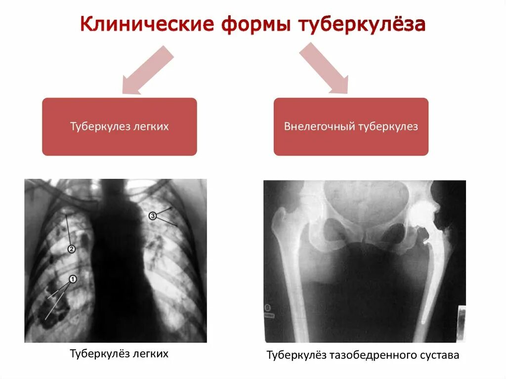 Клинический случай туберкулез. Легочные формы туберкулеза. Клинические формы туберкулеза. Клиничиская формы туберкулеза. Клинические проявления лёгочного туберкулёза:.