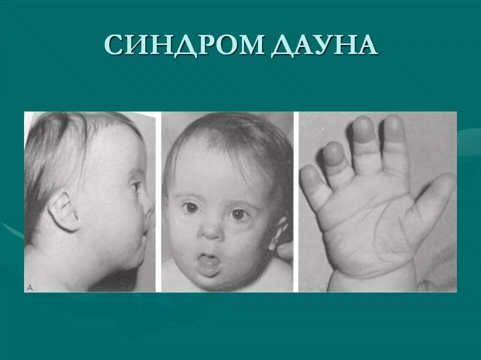 Синдром Дауна. Новорожденные с синдромом Дауна. Лишняя 21 хромосома