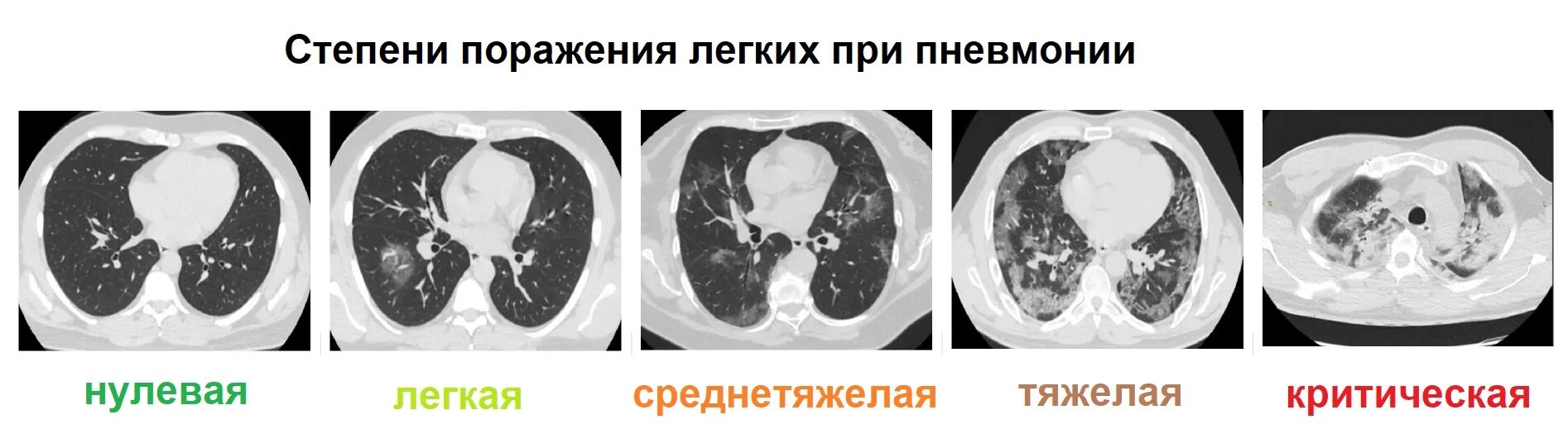 Стадии поражения легких. Поражение легких при коронавирусе. Степени поражения легких при коронавирусе по кт. 50 процентов легких