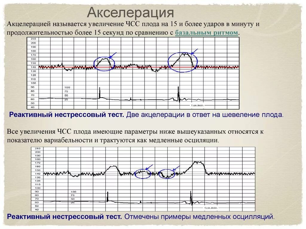 Плод тест 1. КТГ нормальный Тип Кривой. Патологический Тип Кривой КТГ. КТГ плода расшифровка акцелерации и децелерации. Вариабельность сердечного ритма по КТГ.