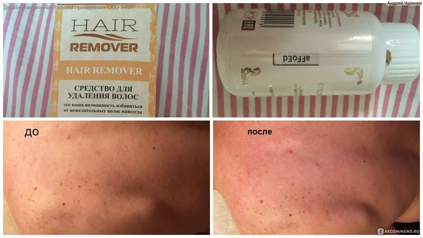 Как убрать волосы навсегда в интимных. Hair remover средство. от депилятора волосы исчезли. хаер ремувер для депиляции применение пошагово.