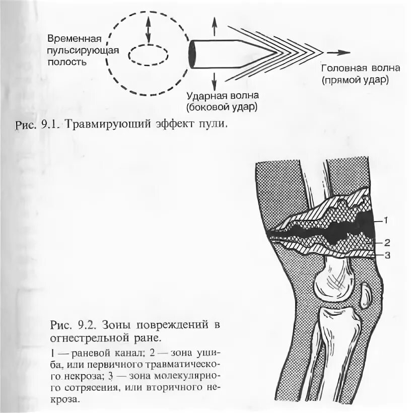Зоны огнестрельного ранения. Зоны раневого канала при огнестрельном ранении.