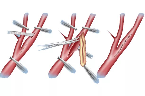 Каротидная эндартерэктомия. Операция каротидная эндартерэктомия. Трансаортальная тромбэндартерэктомия. Эндартерэктомия нижних конечностей. Эндартерэктомия это