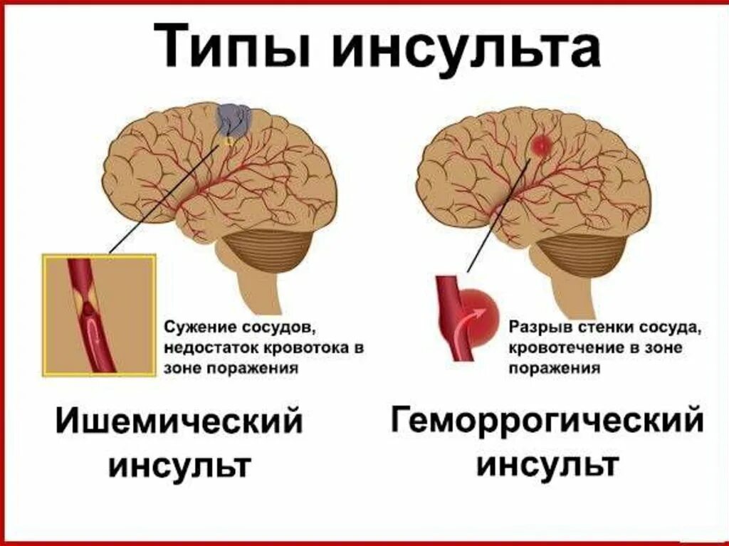 Что случается после инсульта. Инсульт. Виды инсульта. Исудьт.