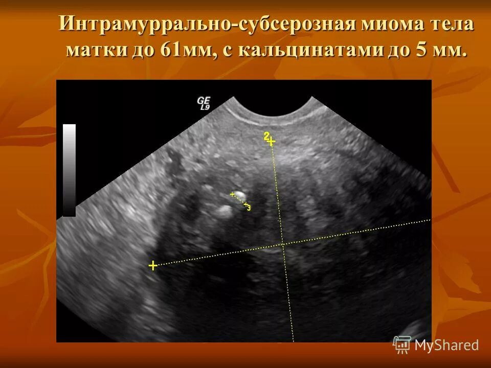 Кальцинированная миома матки на УЗИ. Субсерозная миома матки УЗИ. Субсерозная многоузловая миома матки.