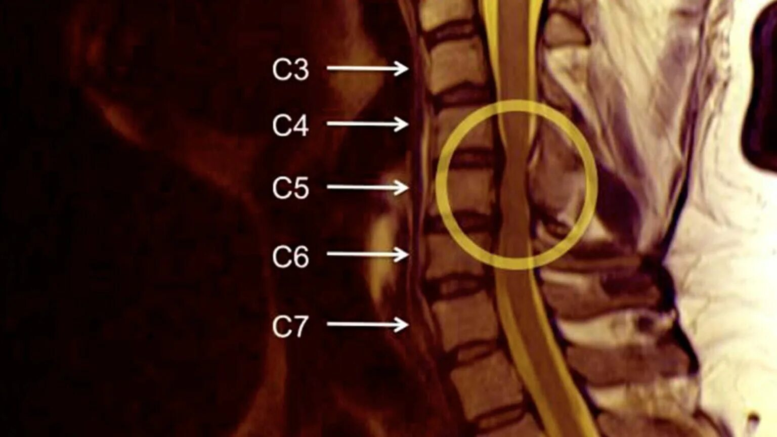 3 4 5 межпозвоночного диска. C3 c4 c5 c6 c7 позвонковых дисков. Межпозвонковые диски c5 c6 c7. C5-c6 межпозвонковый диск. Протрузии дисков c3-c5, c6-c7.
