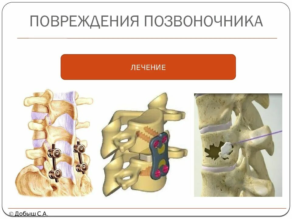Повреждение позвонков