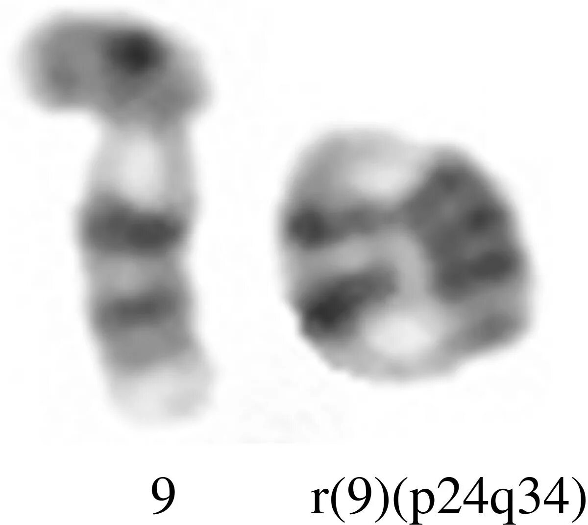 Имеется кольцевая хромосома. Делеция короткого плеча 9 хромосомы.