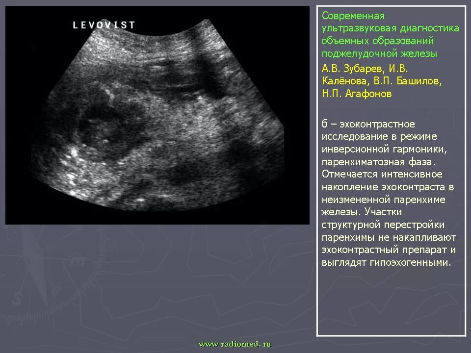 Очаговые изменения поджелудочной. Гиперэхогенное образование поджелудочной железы УЗИ. Ультрасонография поджелудочной железы. Доброкачественные образования поджелудочной железы УЗИ. Очаговые образования поджелудочной железы на УЗИ.