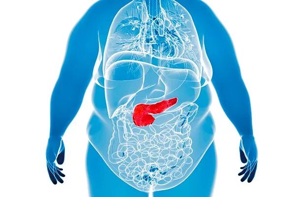 Ожирение поджелудочной лечение. Шунтирование поджелудочной железы. Хронический панкреатит поджелудочная железа. Ожирение поджелудочной железы. Окружность живота метаболический синдром.