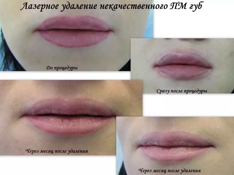 Губы после лазерного. Губы после перманентного макияжа. Перманентный макияж губ до и после.