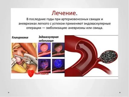 Восстановление после аневризмы