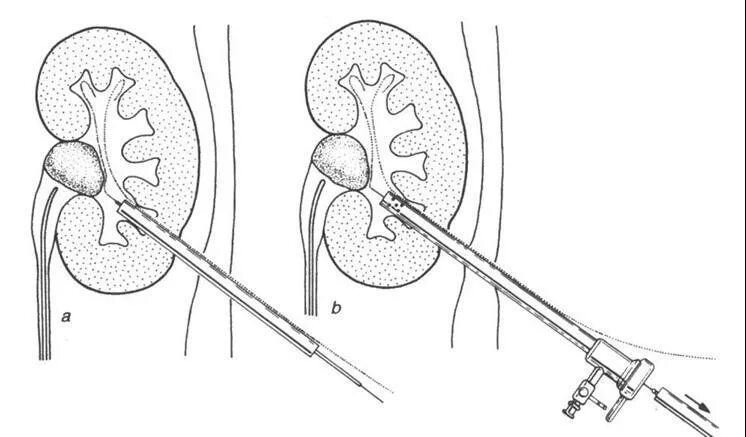 Как дробят камни в мочеточнике. Перкутанная нефролитолапаксия почки. Чрескожная пункционная нефролитотрипсия. Чрескожная перкутанная нефролитотрипсия. Перкутанная нефролитотрипсия при камнях почек.