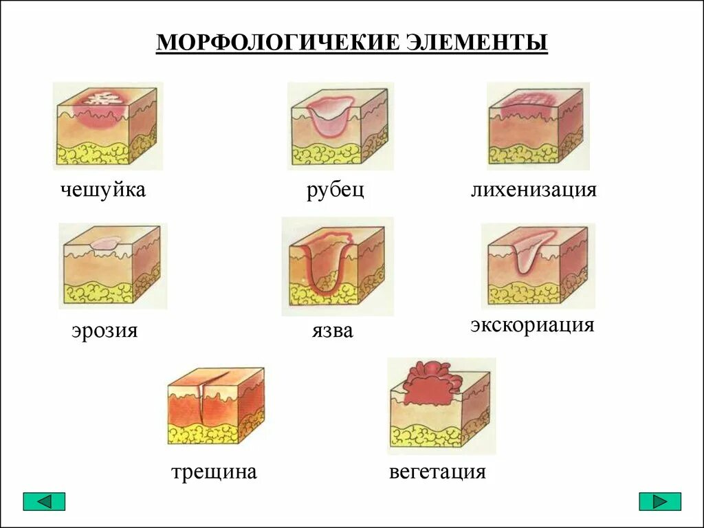 Вторичные элементы поражения