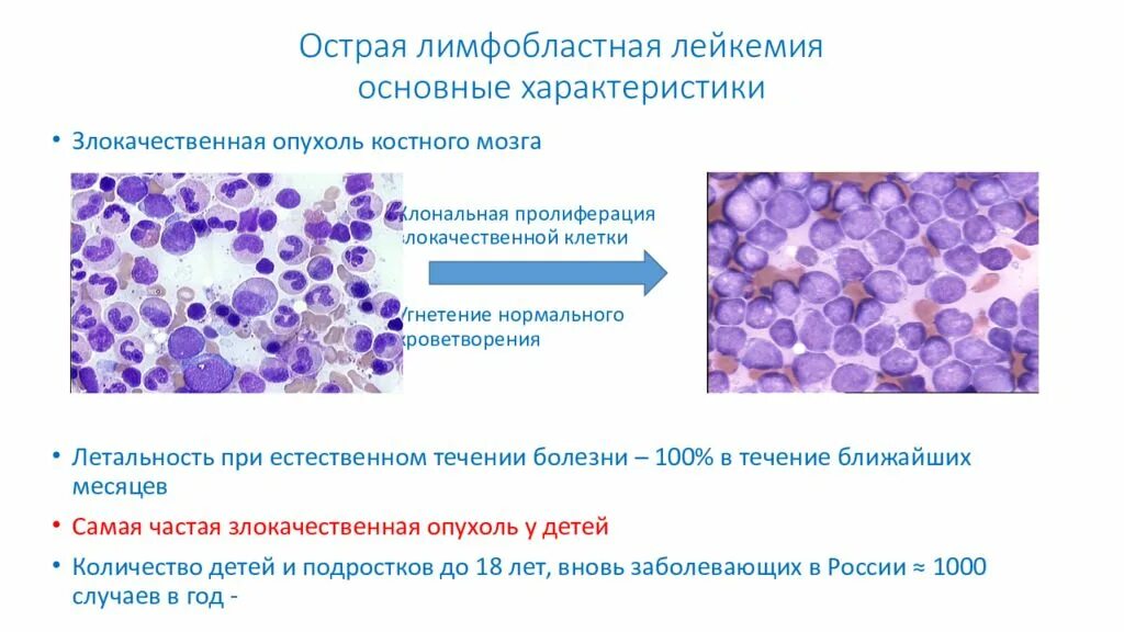 Острый лимфобластный лейкоз. Острый лимфобластный лейкоз костный мозг. Острый лимфобластный лейкоз статистика. Острый лимфобластный лейкоз 4 типа. Лимфобластный лейкоз у взрослых