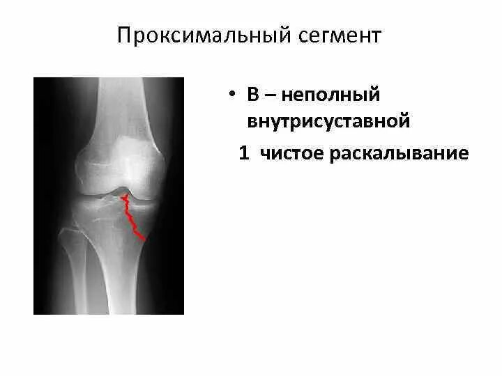 Перелом внутреннего мыщелка большеберцовой кости рентген. Внутрисуставной перелом мыщелков большеберцовой кости. Краевой перелом мыщелка большеберцовой кости рентген. Рентгеновский снимок перелом мыщелка большеберцовой кости.