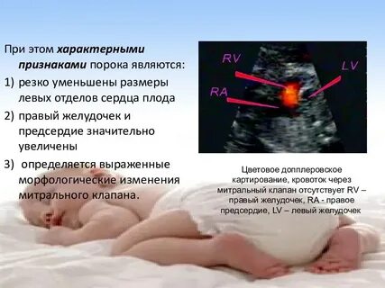 Пороки развития на узи
