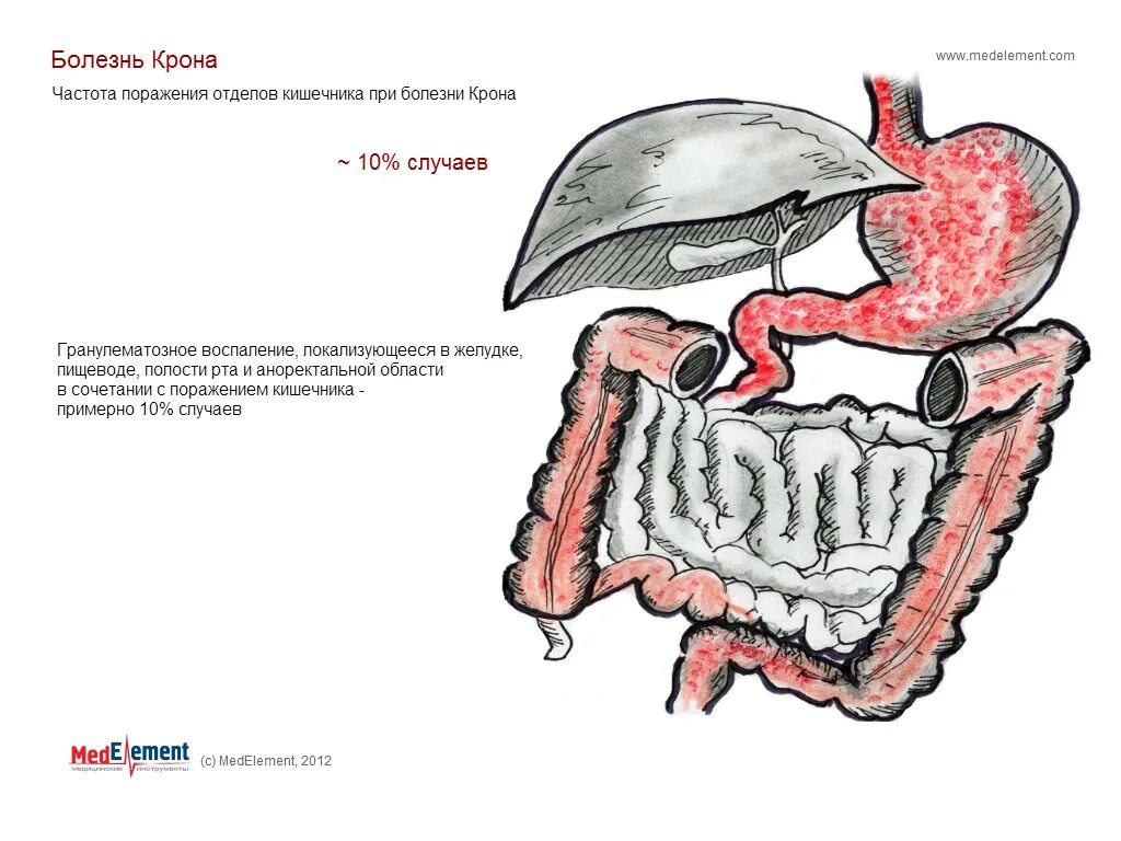 Болезнь крона механизм развития. Схема поражения кишки при болезни крона. Болезнь крона этиология. Крон болезнь кишечника лечение