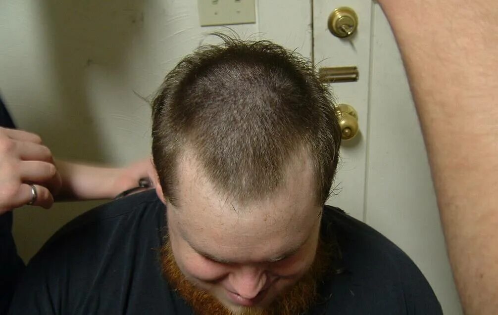 Редеют волосы. Полоска лысины на голове. Начало облысения у мужчин. Ранняя стадия облысения. Прически с лысиной на голове.