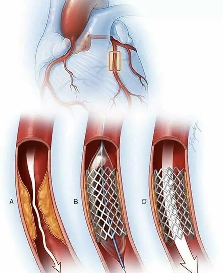 Как выглядит шунт. Стентирование коронарных артерий. Коронарное стентирование сосудов сердца. Шунтирование сосудов сердца стент.