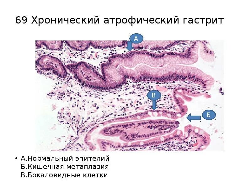 Метаплазия желудка гистология. Кишечная метаплазия желудка гистология. Метаплазия механизм развития. Тонкокишечная метаплазия гистология. Кишечная метаплазия желудка микропрепарат.