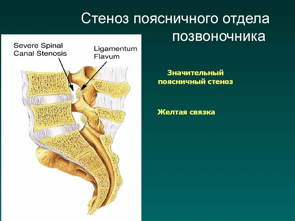 Желтая связка позвоночника. Желтая продольная связка позвоночника. Жолтаясвязкапоясничногоотдела. Желтая связка позвоночника анатомия. Крестцовый стеноз