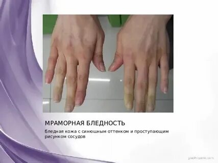 Мраморная бледность фразеологизм