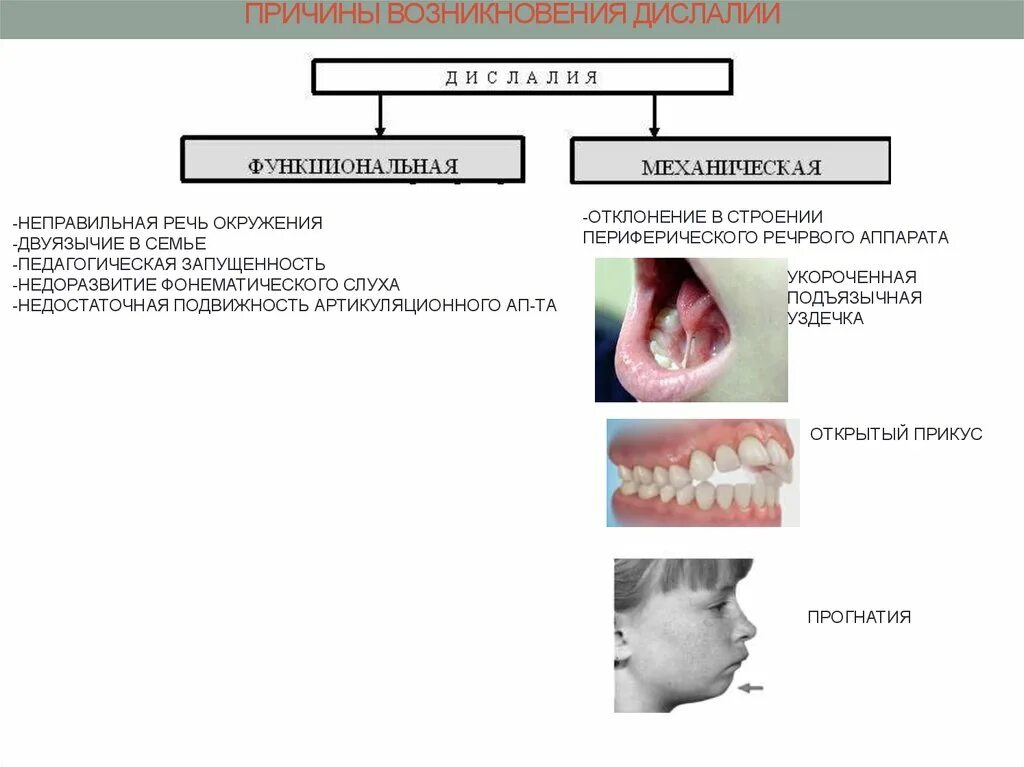 Строение артикуляционного аппарата при дислалии. Причины дефектов строения артикуляционного аппарата:. Строение речевого аппарата механическая дислалия. Подвижность артикуляционного аппарата при дислалии. Артикуляторная дислалия