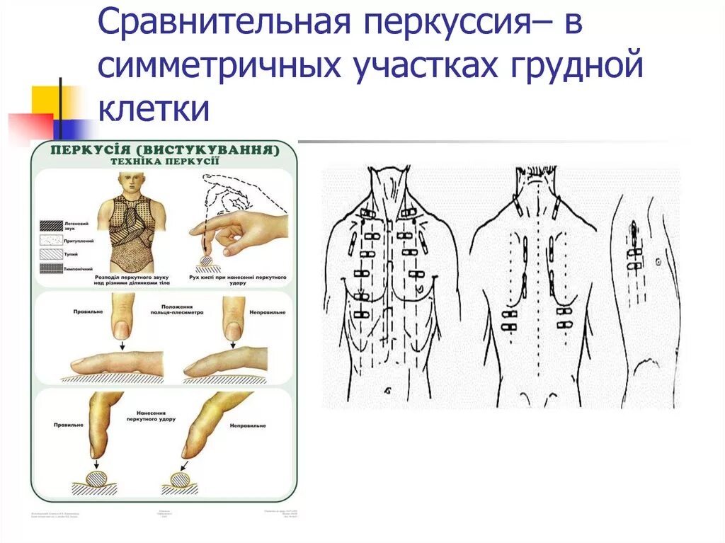Алгоритм сравнительной перкуссии. Точки сравнительной перкуссии грудной клетки. перечислите ориентиры для перкуссии спереди.. перкуссия грудной клетки пропедевтика. сравнительная перкуссия легких пропедевтика.