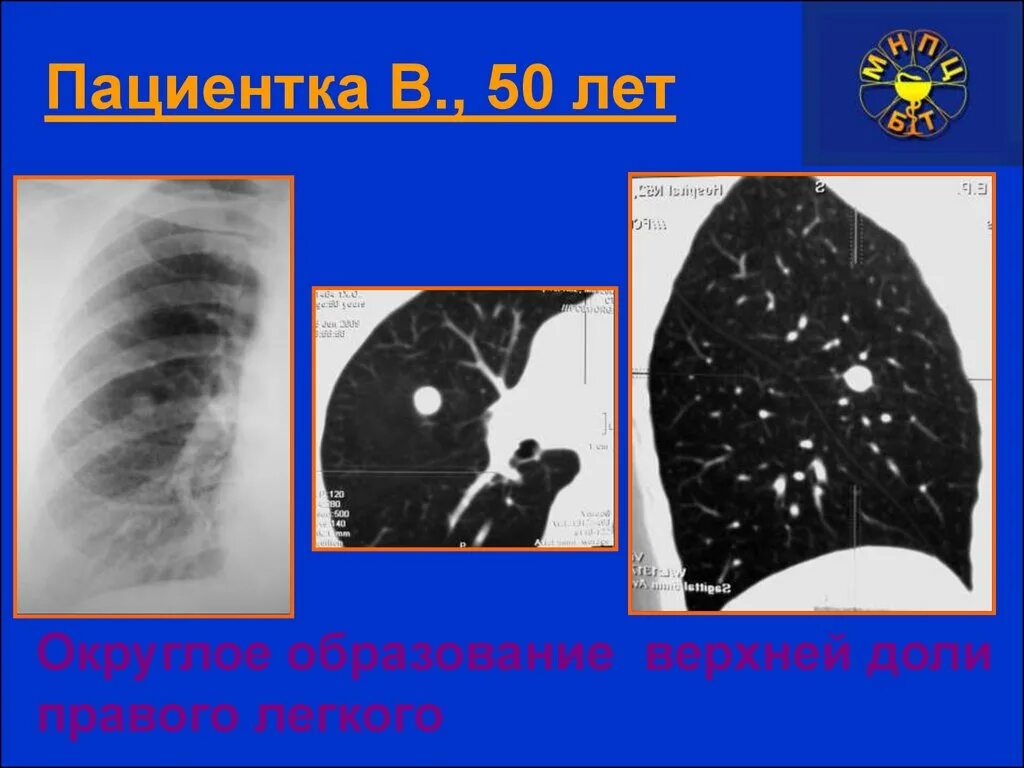 Затемнение верхней доли легкого. Округлое образование в легких. Затемнение верхней доли правого легкого. Туберкулома верхней доли правого лёгкого. Округлое образование в корне правого легкого.