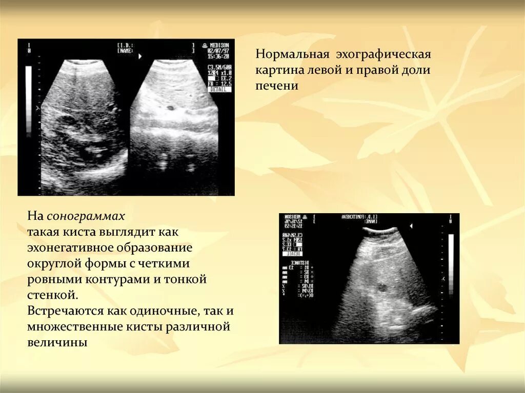 Эхографическая картина. Киста правой доли печени. Образования печени по УЗИ. Сонограмма киста печени. Округлые образования печени