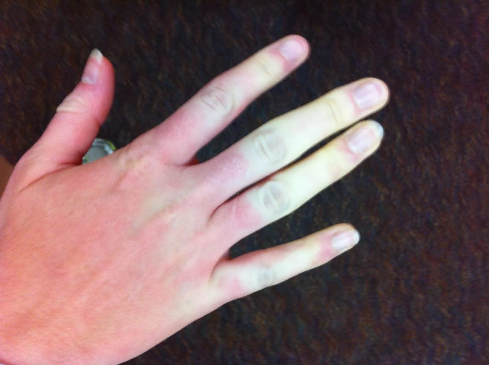 Почему пальцы можно. Акроцианоз синдром Рейно. Синдром Рейно кисти рук. Ангиотрофоневрозы. Болезнь Рейно..
