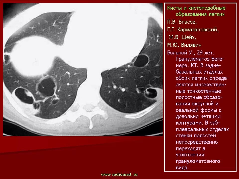 Полостные образования на кт. Тонкостенные полостные образования в легких. Полостные образования в легких