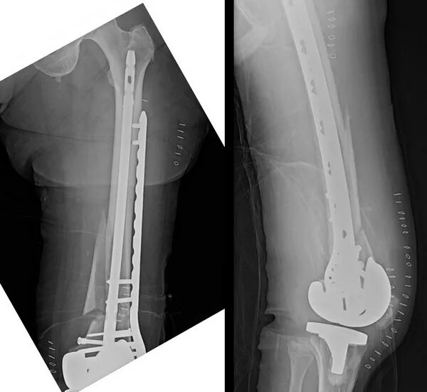 Перипротезный перелом бедра рентген. Перипротезный перелом тазобедренного сустава. Перипротезный перелом коленного сустава. Перипротезный остеомиелит бедренной кости. Реабилитация после перелома бедренной кости после операции