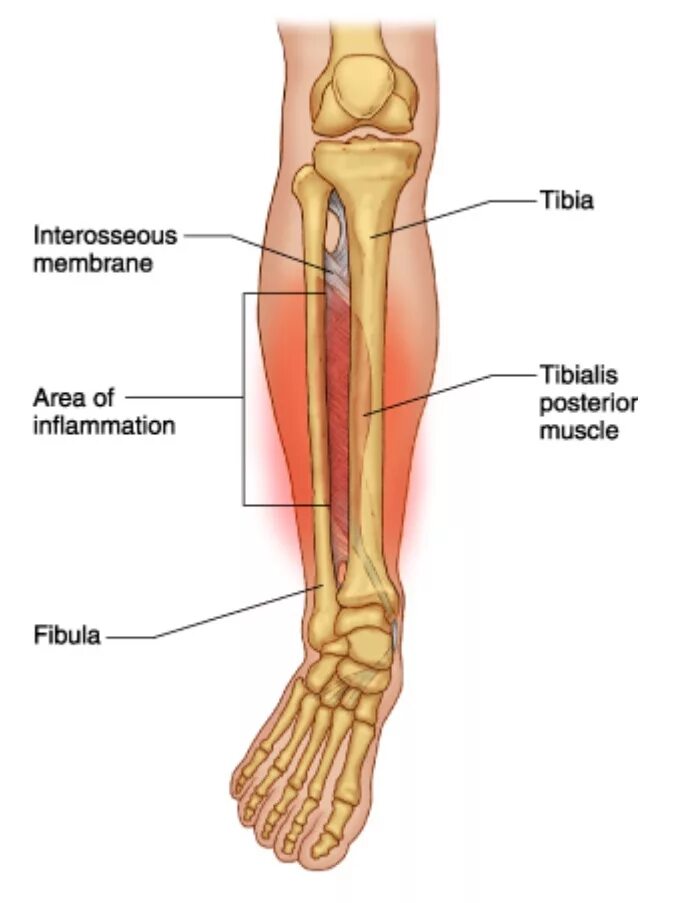 Надкостница большеберцовой кости болит.
