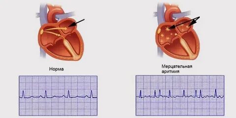 Признаки мерцательной аритмии сердца у женщин