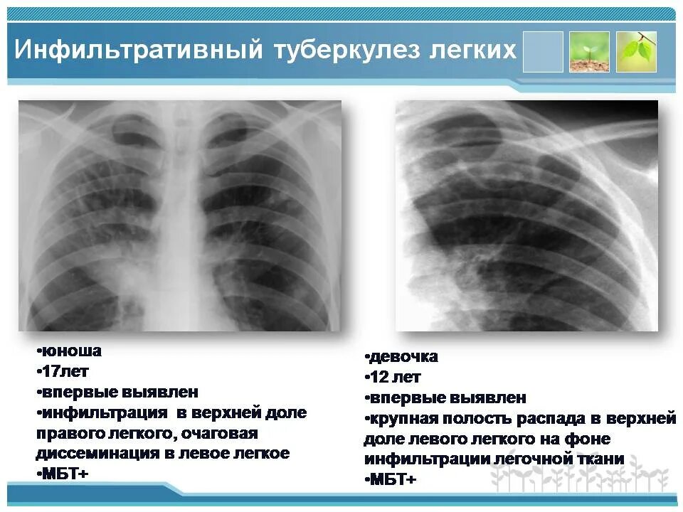 Инфильтративный туберкулез s6. Инфильтративный туберкулез рентген. Инфильтративная пневмония рентген. Инфильтративный туберкулез Лобит рентген.