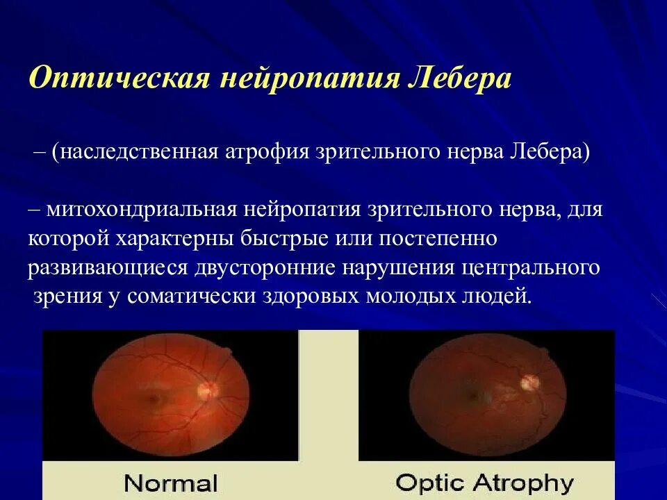 Нейропатия зрительных. Наследственная зрительного нерва Лебера. Атрофия зрительного нерва Лебера. Оптическая нейропатия Лебера. Атрофия зрительного нерва Либеро.